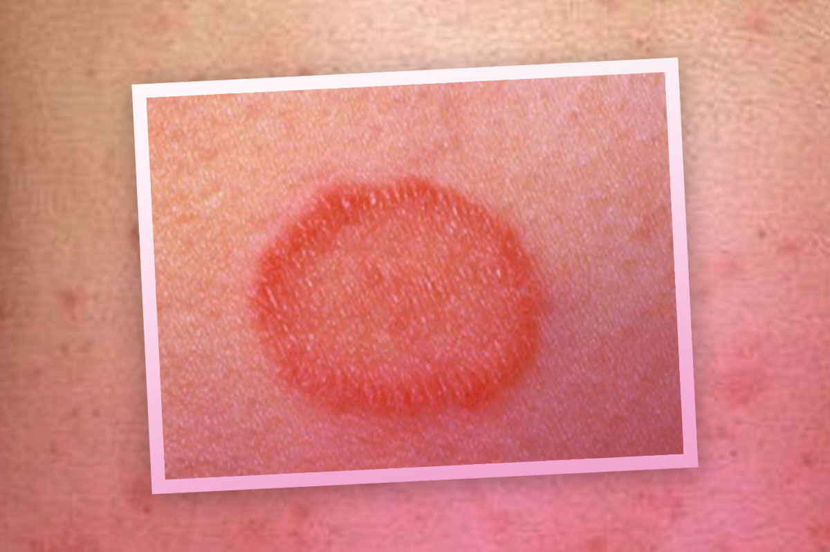 Pitiriasis rosada de Gibert